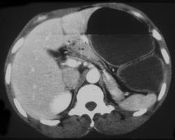 Volvulus - CTisus CT Scan