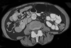 Normal Appendix - CTisus CT Scan