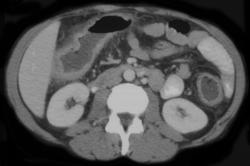 Ulcerative Colitis - CTisus CT Scan