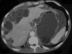 Pseudomyxoma Peritonei (PMP) - CTisus CT Scan