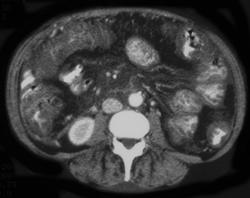 Pseudomembranous Colitis (PMC) - CTisus CT Scan