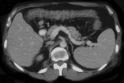 Cytomegalovirus (CMV) Colitis in AIDS Patient - CTisus CT Scan