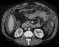 Tuberculosis (TB) Peritonitis - CTisus CT Scan