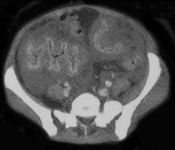 Pseudomembranous Colitis (PMC) - CTisus CT Scan