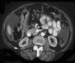 Ascending Colon Cancer With Carcinomatosis - CTisus CT Scan