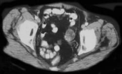 Diverticulitis W/focal Perforation - CTisus CT Scan