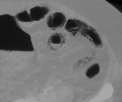 Pneumatosis Coli - CTisus CT Scan