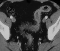 Ulcerative Colitis - CTisus CT Scan