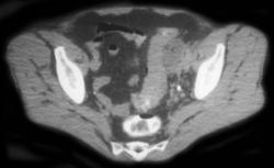 Diverticulitis W/focal Abscess - CTisus CT Scan