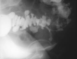 Diverticulitis W/perforation - CTisus CT Scan