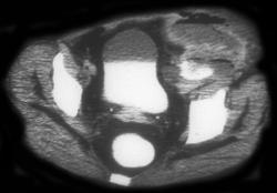 Diverticulitis W/abscess Into Abdominal Wall - CTisus CT Scan