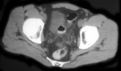 Colovesical Fistulae Secondary to Diverticulitis - CTisus CT Scan