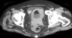 Colovaginal Fistulae Due to Cervical Cancer - CTisus CT Scan