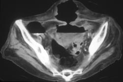 Diverticulitis W/fistulae Extending Through Abdominal Wall - CTisus CT Scan