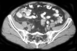 Right Sided Diverticulitis - CTisus CT Scan