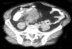 Right Sided Diverticulitis W/abscess - CTisus CT Scan