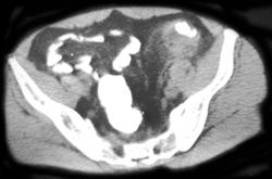 Diverticulitis - CTisus CT Scan