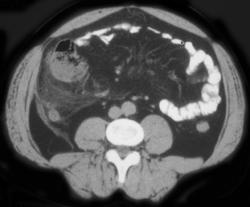 Appendicitis - CTisus CT Scan