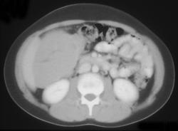 Melanoma Metastatic to Cecum - CTisus CT Scan