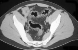 Ulcerative Colitis - CTisus CT Scan