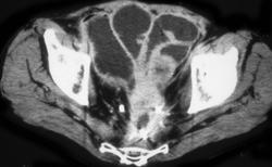 Small Bowel Obstruction (SBO) Due to Recurrent Rectal Cancer - CTisus CT Scan