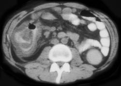 Pseudomembranous Colitis (PMC) - CTisus CT Scan