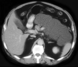 Lymphangioma - CTisus CT Scan