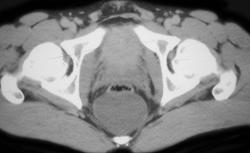 Rectal Duplication Cyst - CTisus CT Scan