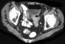 Colovesical Fistulae - CTisus CT Scan