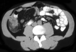 Appendicitis - CTisus CT Scan