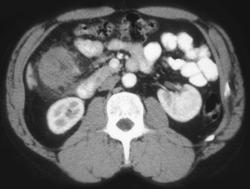 Ischemic Colitis - CTisus CT Scan