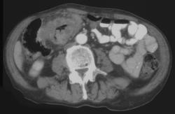 Colon Cancer - CTisus CT Scan