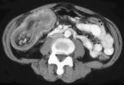 Intussusception of A Cecal Cancer - CTisus CT Scan