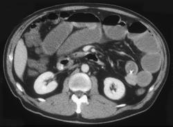 Small Bowel Obstruction (SBO) Due to A Cecal Carcinoma - CTisus CT Scan