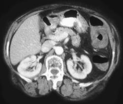 Ischemic Colitis- Splenic Flexure - CTisus CT Scan