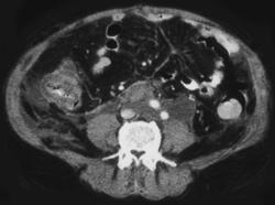 Appendicitis - CTisus CT Scan