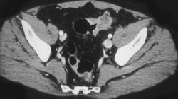 Invasive Sigmoid Cancer - CTisus CT Scan