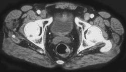 Rectal Wall Cancer - CTisus CT Scan