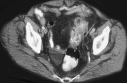 Diverticulitis W/fistulae - CTisus CT Scan