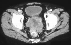 Bulky Rectal Cancer W/tube in Rectum - CTisus CT Scan