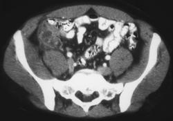 Appendicitis - CTisus CT Scan