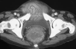 Rectal Lymphoma - CTisus CT Scan