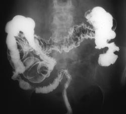 Lymphoma of the Transverse Colon - CTisus CT Scan