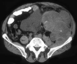 Retroperitoneal Sarcoma - CTisus CT Scan