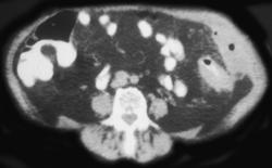 Diverticulitis W/fistulae to Abdominal Wall - CTisus CT Scan