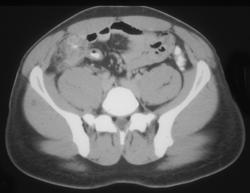 Appendicitis - CTisus CT Scan