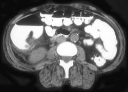 Appendicitis - CTisus CT Scan