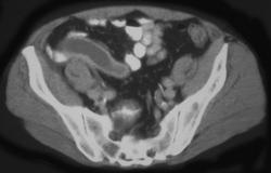 Appendicitis Due to Obstruction By Cecal Cancer - CTisus CT Scan