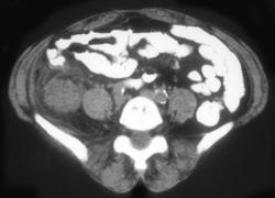 Appendicitis - CTisus CT Scan