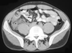 Appendicitis - CTisus CT Scan